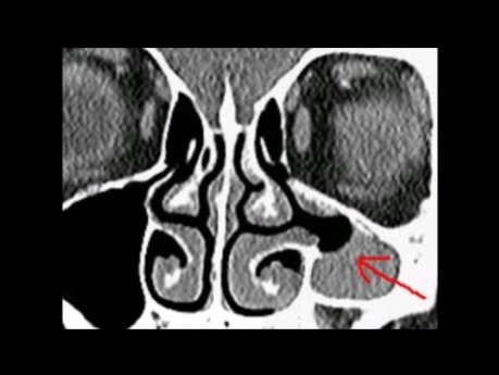 Atelectasia del seno maxilar izquierdo