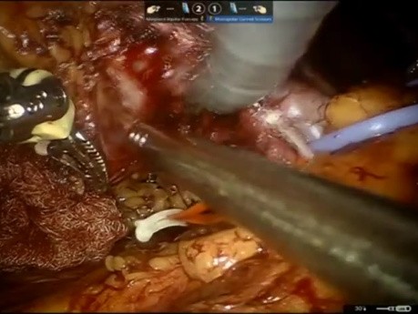 Enucleación robótica de un tumor del hilio renal