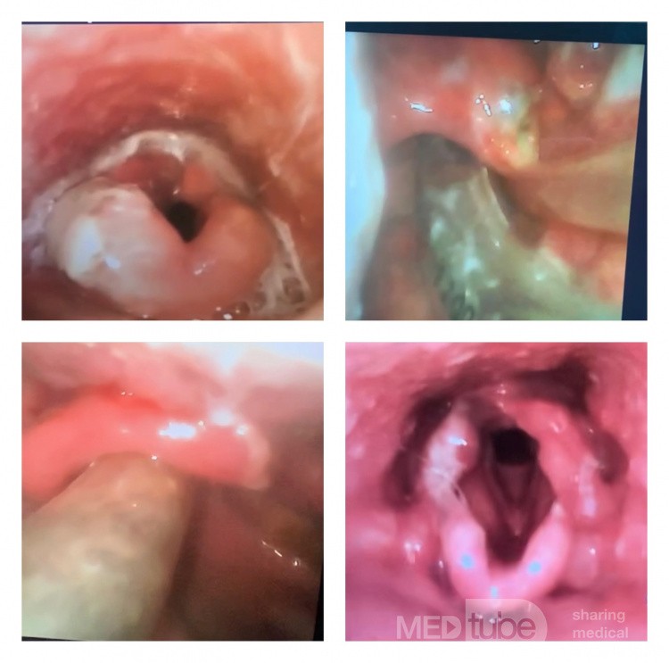 Epiglotitis aguda con absceso epiglótico