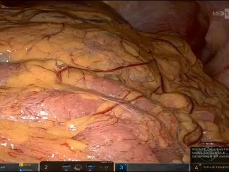Colectomía robótica derecha oncológica para tumor de colon en ángulo hepático