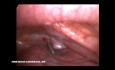 Extracción de una puñalada en el cuello con toracoscopia asistida por video. Unidad de Trauma y Cirugía Cardiovascular