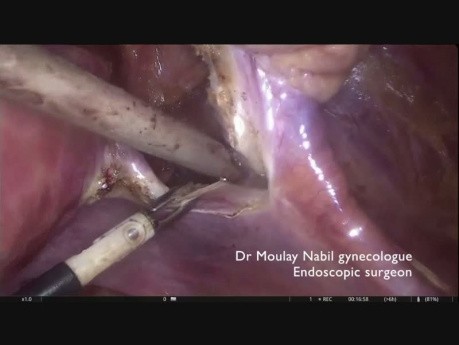 Transposición ovárica durante la histerectomía radical para el cáncer de cuello uterino en etapa temprana