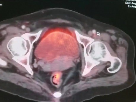 Resección y reconstrucción de la vena cava inferior (paraganglioma recurrente)