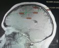 Planificación quirúrgica con neuronavegador en paciente con lesión de masa intracraneal. Glioma de alto grado.