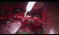 Disección del ganglio linfático derecho retroperitoneal