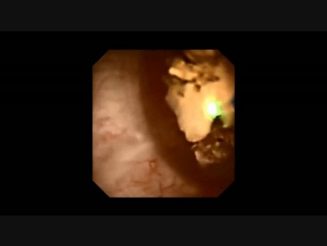 Cirugía retrógrada intrarrenal (RIRS) - piedras caliceales superior e inferior