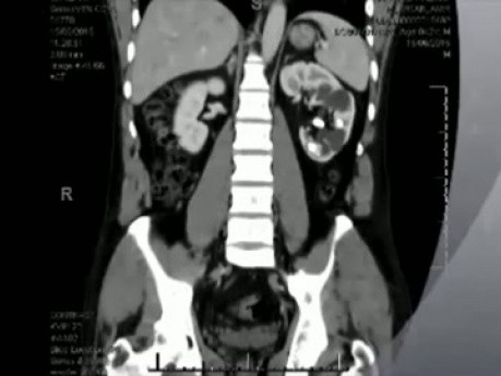 Cirugía retrógrada intrarrenal (RIRS) - litotricia con láser