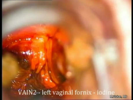 Colposcopia de vagina