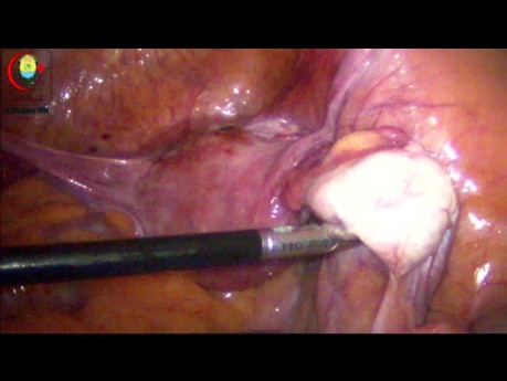 Examen de los anexos y el colon sigmoide en el abdomen agudo