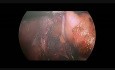 Funduplicatura laparoscópica de Nissen en niño de 17 meses