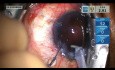 Cirugía de Cataratas con Rescate de Capsulorrexis Posterior