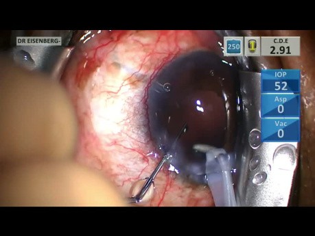 Cirugía de Cataratas con Rescate de Capsulorrexis Posterior