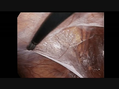 Reparación laparoscópica de hernia inguinal - paso 3 - incisión peritoneal izquierda