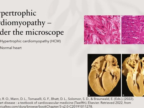Actualización de 2022 de ecocardiografía e imágenes cardiovasculares multimodales en la miocardiopatía hipertrófica