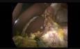 Gastrectomía subtotal asistida por laparoscopia con linfadenectomía D2 y reconstrucción en Y de Roux 