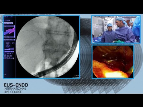 ARF biliar y colocación de stents