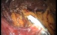 Reparación laparoendoscópica de sitio único (LESS) de hernia de Morgagni y fundoplicatura de Toupet