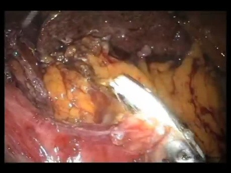 Reparación laparoendoscópica de sitio único (LESS) de hernia de Morgagni y fundoplicatura de Toupet