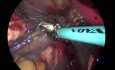 vNOTES Histerectomía para hiperplasia endometrial