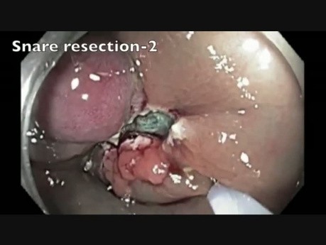Perforación del colon tras RME - E