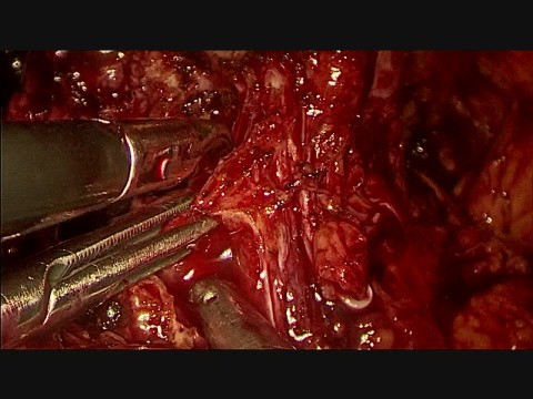 Laparoscopic prostatectomy