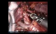 Tri-segmentectomía pulmonar robótica del lóbulo superior izquierdo