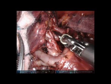 Tri-segmentectomía pulmonar robótica del lóbulo superior izquierdo