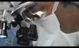 Rinoplastia: Antes y después de la cirugía de nariz