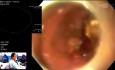 Procedimiento de CPRE con gastroscopio