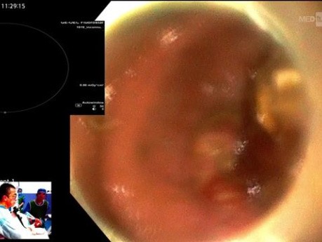 Procedimiento de CPRE con gastroscopio