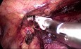 Esofagectomía toracoscópica