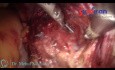 Histerectomía Total Laparoscópica en Caso con Cesárea previa