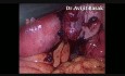Manejo laparoscópico del embarazo ectópico ovárico
