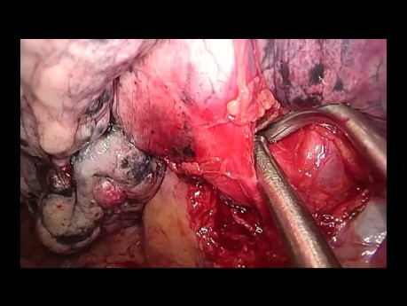Trisegmentectomía superior izquierda anatómica uniportal VATS (no editada)