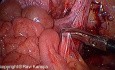 Orquiopexia laparoscópica de Fowler-Stephens en dos etapas en el tratamiento de los testículos intraabdominales