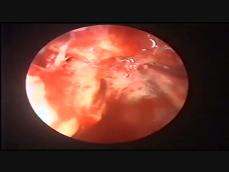 Colesteatoma en el ático con otorrea de líquido cefalorraquídeo