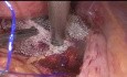 Suspensión uterica laparóscopica