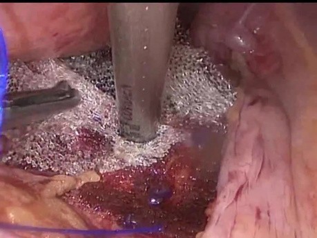Suspensión uterica laparóscopica