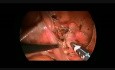 Resección laparoscópica del quiste de uraco en un niño