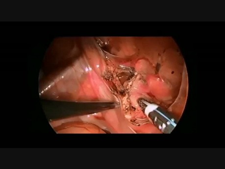 Resección laparoscópica del quiste de uraco en un niño