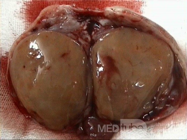 Arrenoblastoma 