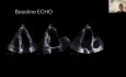 Ecocardiografía en Cardio-Oncología