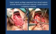 Corrección de la desviación del tabique caudal con plastia de punta nasal