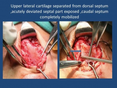 Corrección de la desviación del tabique caudal con plastia de punta nasal