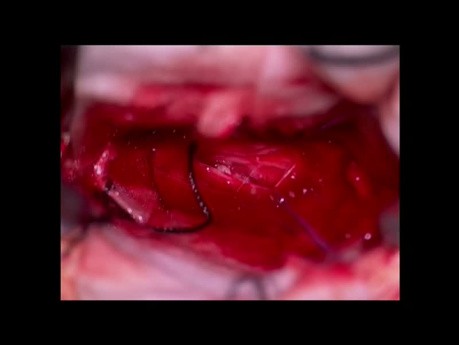 Hernia de disco de localización intradural