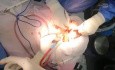 Fractura de angulo mandibular izquierda por intento de extracción