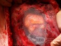 El defecto en la pared torácica cubierta con malla de polipropileno, el pericardio intacto después de la extirpación del liposarcoma de la mama izquierda