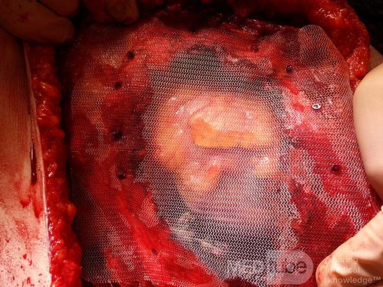 El defecto en la pared torácica cubierta con malla de polipropileno, el pericardio intacto después de la extirpación del liposarcoma de la mama izquierda