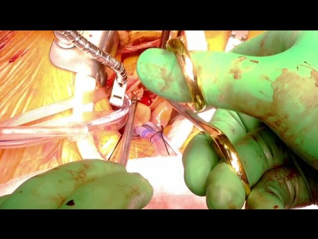 Reemplazo de válvula aórtica por toracotomía anterior derecha. Prótesis Avalus.