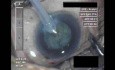 Cirugía de cataratas 2 - Parte 2